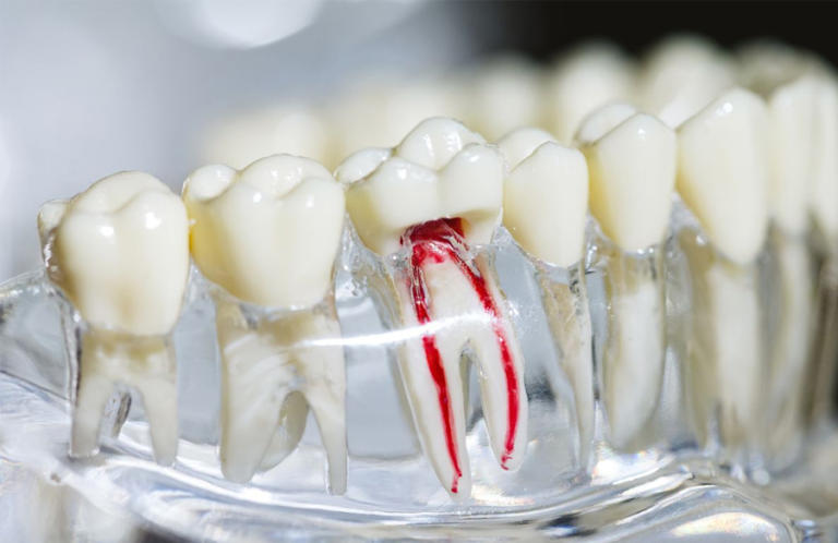 Root Canal Treatment in Queen Creek