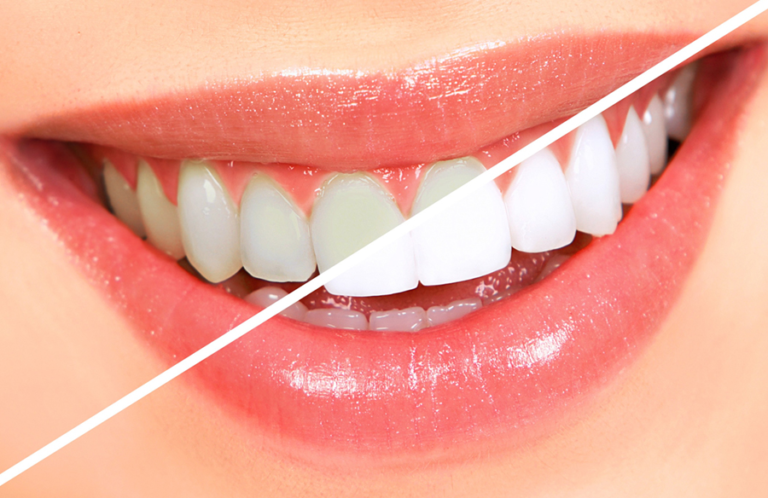 Teeth Whitening in Queen Creek